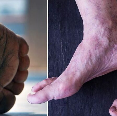 Symptômes de carence en vitamine B12: trois signes avant-coureurs sur vos pieds à surveiller