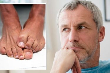 Symptômes du diabète de type 2: la pilosité de vos pieds peut indiquer une glycémie élevée