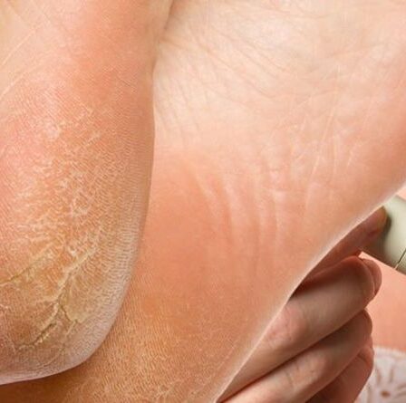 Symptômes du diabète de type 2: les callosités aux pieds sont un signe d'avertissement - que sont-elles?