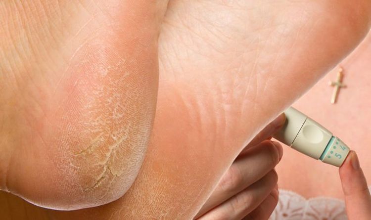 Symptômes du diabète de type 2: les callosités aux pieds sont un signe d'avertissement - que sont-elles?