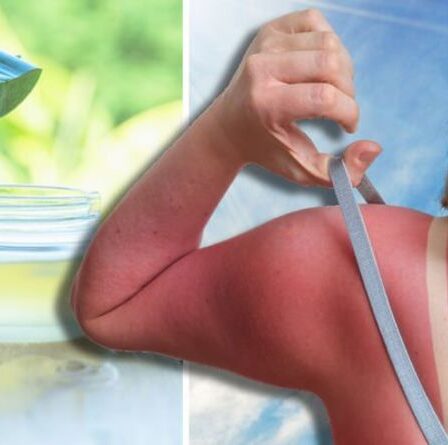 Comment apaiser les coups de soleil - 5 conseils pour rafraîchir la peau brûlée