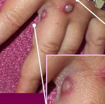 L'épidémie de Monkeypox déclenche une campagne de vaccination d'urgence pour arrêter la propagation du virus alors que les cas sont confirmés