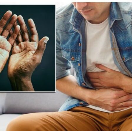 Symptômes de la stéatose hépatique : quatre signes sur la main peuvent indiquer que votre organe est endommagé