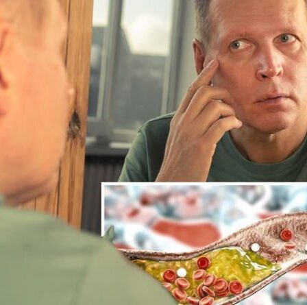 Symptômes d'hypercholestérolémie : deux signes avant-coureurs sur votre visage d'un taux de cholestérol élevé