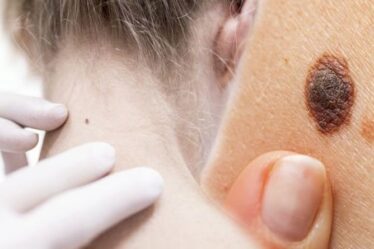 Cancer de la peau : huit signes majeurs avertissant que votre imperfection ou grain de beauté peut être cancéreux
