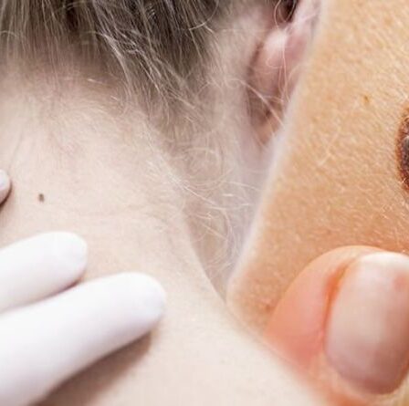 Cancer de la peau : huit signes majeurs avertissant que votre imperfection ou grain de beauté peut être cancéreux