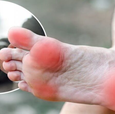 Diabète de type 2 : Le signe de la glycémie dans vos pieds qui pourrait conduire à une amputation