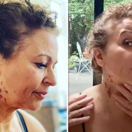 Nadia Sawalha est partie dans une « douleur atroce » alors qu'un accident laisse des brûlures d'horreur « une semaine de l'enfer »