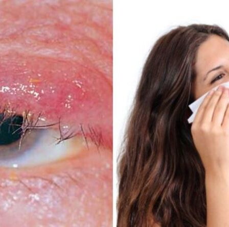 Symptômes de la blépharite : quand consulter un médecin en cas d'inflammation des paupières