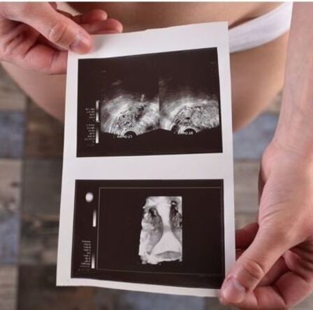 Symptômes du cancer de l'ovaire : quatre des signes « les plus courants » du cancer de l'ovaire
