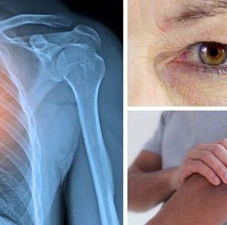 Symptômes du cancer du poumon : cinq « signes et symptômes surprenants » que vous ne devriez jamais ignorer