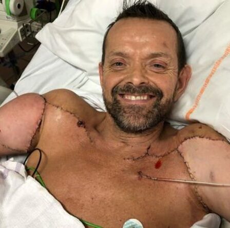 Un homme reçoit la première greffe de bras double au monde - et maintenant il peut fléchir ses biceps