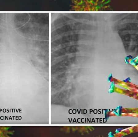 Les rayons X montrent une différence flagrante que font les vaccins Covid – avec des poumons non protégés ravagés par le virus