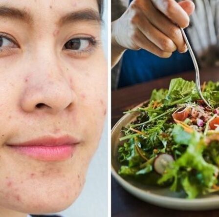 Régime acné : les 3 aliments à éviter pour une peau nette