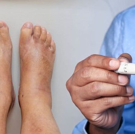 Signes de diabète dans vos pieds - les 14 symptômes à surveiller
