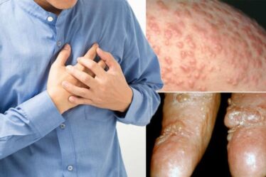 Symptômes des maladies cardiaques : pourquoi vous ne devriez jamais ignorer ces cinq signes subtils sur votre peau