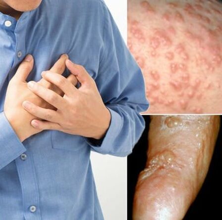 Symptômes des maladies cardiaques : pourquoi vous ne devriez jamais ignorer ces cinq signes subtils sur votre peau