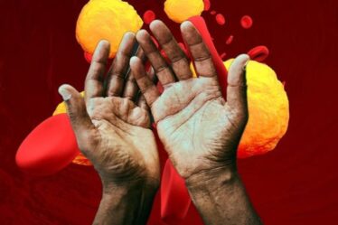 Symptômes d'hypercholestérolémie : le signe d'avertissement sur vos mains de « niveaux malsains »