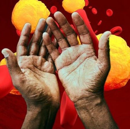 Symptômes d'hypercholestérolémie : le signe d'avertissement sur vos mains de « niveaux malsains »