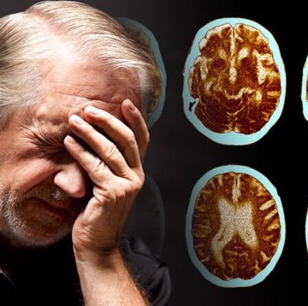 Alerte à la maladie d'Alzheimer : une nouvelle forme agressive de maladie identifiée – frappe au début de la quarantaine