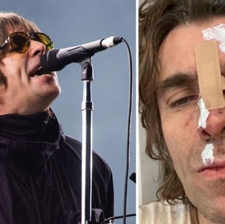 Liam Gallagher est parti avec le visage meurtri et coupé après être " tombé d'un hélicoptère "