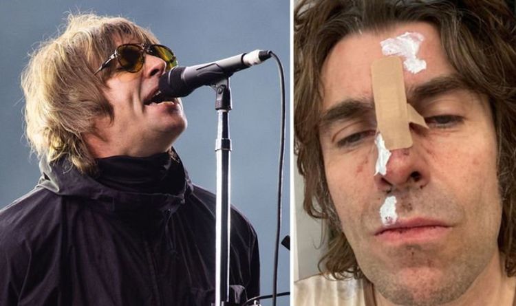 Liam Gallagher est parti avec le visage meurtri et coupé après être " tombé d'un hélicoptère "