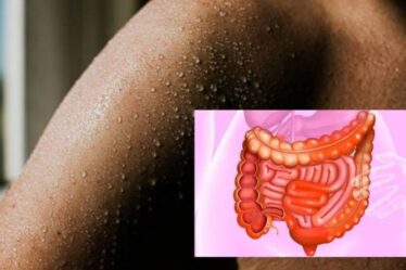 Symptômes de la maladie de Crohn : le signe sur votre peau que vous pourriez avoir la maladie à vie