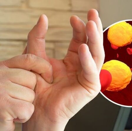 Symptômes d'hypercholestérolémie : le « signe important » de niveaux extrêmement élevés sur votre main
