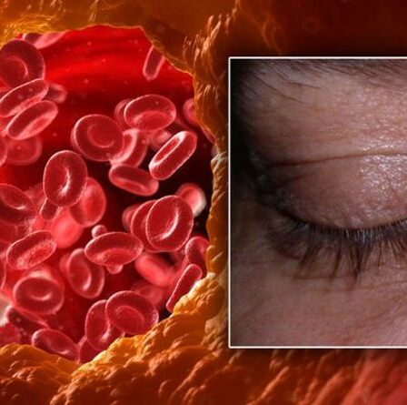 Symptômes d'hypercholestérolémie : signe dans votre œil - avez-vous ces « zones jaunâtres » de la peau ?