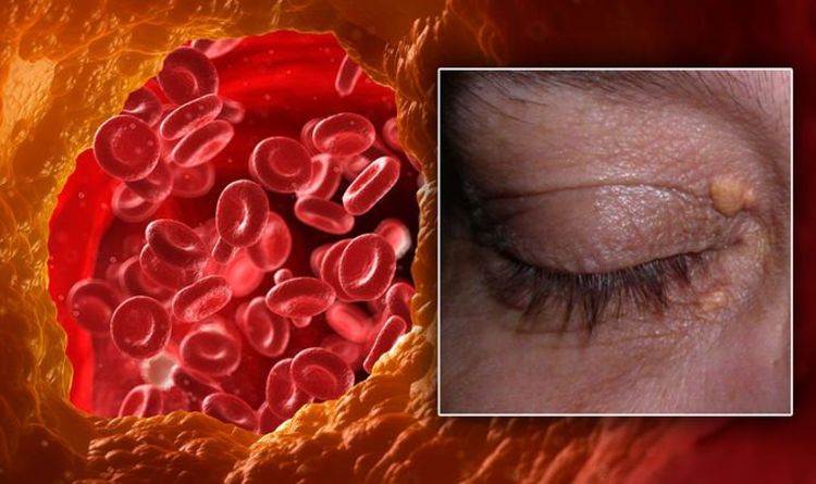 Symptômes d'hypercholestérolémie : signe dans votre œil - avez-vous ces « zones jaunâtres » de la peau ?