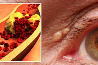 Symptômes d'hypercholestérolémie : signes peu fréquents dans vos yeux indiquant que votre taux est trop élevé