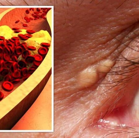 Symptômes d'hypercholestérolémie : signes peu fréquents dans vos yeux indiquant que votre taux est trop élevé