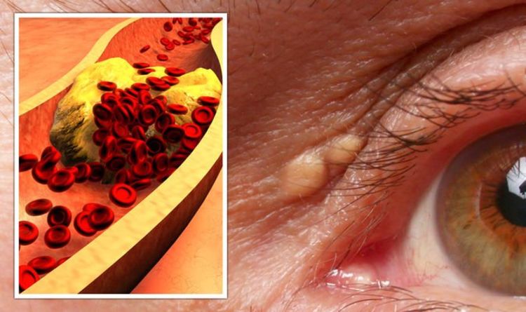 Symptômes d'hypercholestérolémie : signes peu fréquents dans vos yeux indiquant que votre taux est trop élevé