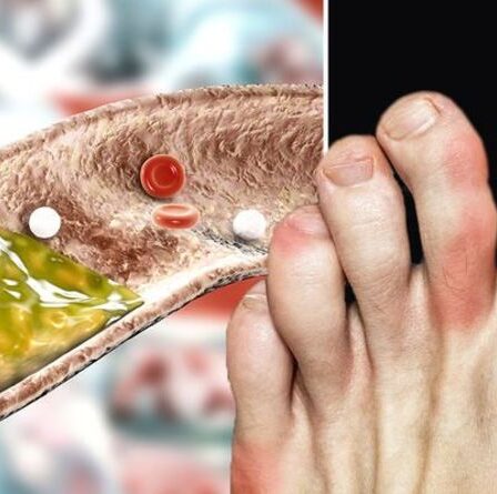 Symptômes d'hypercholestérolémie : trois signes d'avertissement visuels d'un taux élevé de cholestérol sur vos pieds