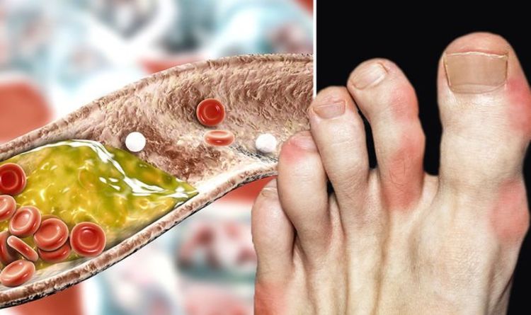 Symptômes d'hypercholestérolémie : trois signes d'avertissement visuels d'un taux élevé de cholestérol sur vos pieds