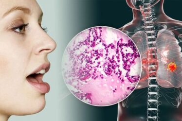 Symptômes du cancer du poumon : le signe dans votre voix que vous pourriez avoir la maladie mortelle