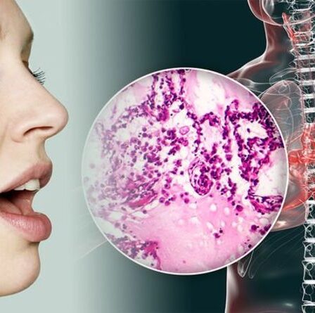 Symptômes du cancer du poumon : le signe dans votre voix que vous pourriez avoir la maladie mortelle