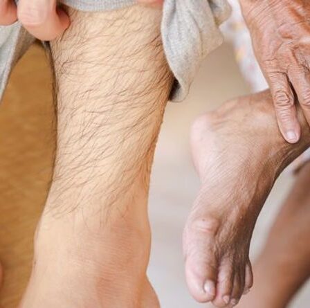 Taux de cholestérol élevé : cinq signes dans vos jambes auxquels vous devez vous attaquer "le plus tôt possible"
