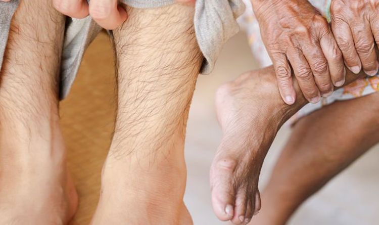 Taux de cholestérol élevé : cinq signes dans vos jambes auxquels vous devez vous attaquer "le plus tôt possible"