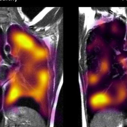 Horreur de Covid: les lésions pulmonaires cachées du coronavirus exposées dans des scans terrifiants