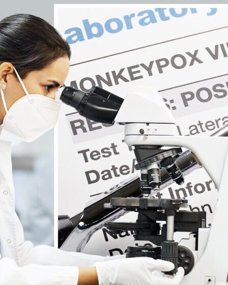 "Plus qu'une maladie cutanée superficielle", un médecin de Liverpool partage une "grande surprise" sur le monkeypox