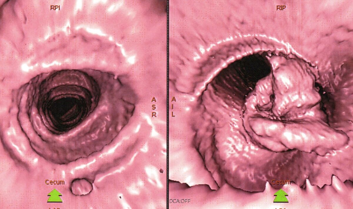 La caméra robot 'Worm' 'rend le dépistage du cancer de l'intestin plus confortable'