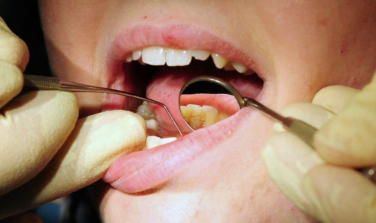 Les gens « arrachent leurs propres dents » en raison de la crise dentaire du NHS