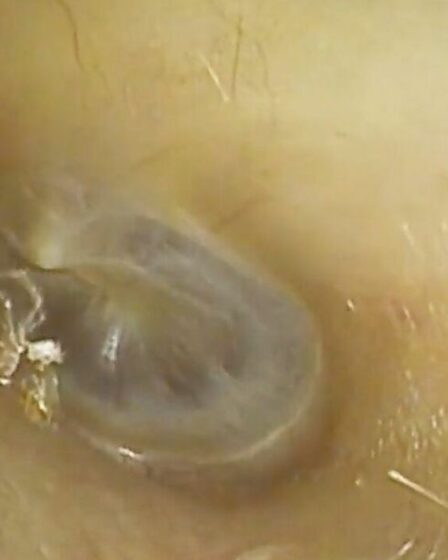 Horreur : une araignée trouvée dans l'oreille d'une femme après qu'elle se soit plainte d'un « bruissement »