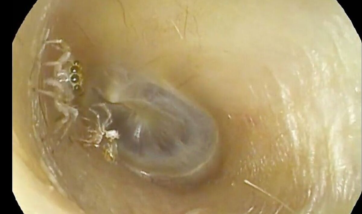 Horreur : une araignée trouvée dans l'oreille d'une femme après qu'elle se soit plainte d'un « bruissement »