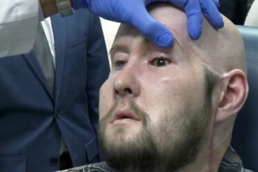 Un homme reçoit la première greffe d'œil entier au monde et un nouveau visage après un accident d'horreur