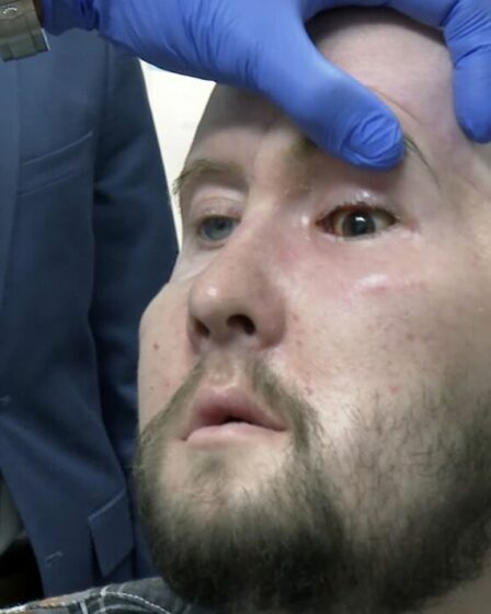 Un homme reçoit la première greffe d'œil entier au monde et un nouveau visage après un accident d'horreur