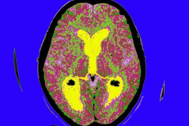 Des cerveaux préservés vieux de 12 000 ans pourraient apporter des réponses sur la maladie d'Alzheimer
