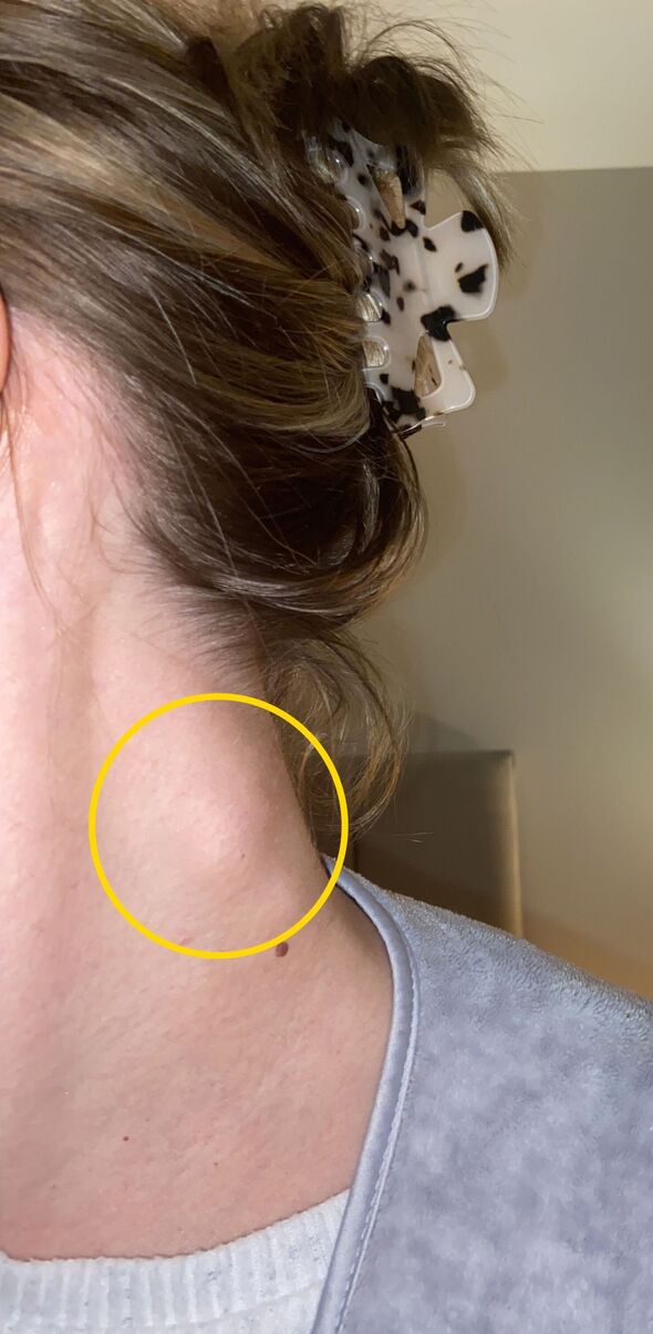 Ganglion lymphatique enflé sur le cou