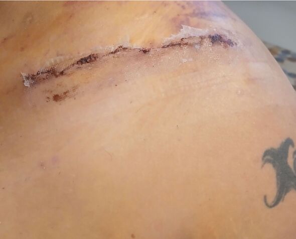 Une profonde entaille sur l'épaule de M. Antonetty